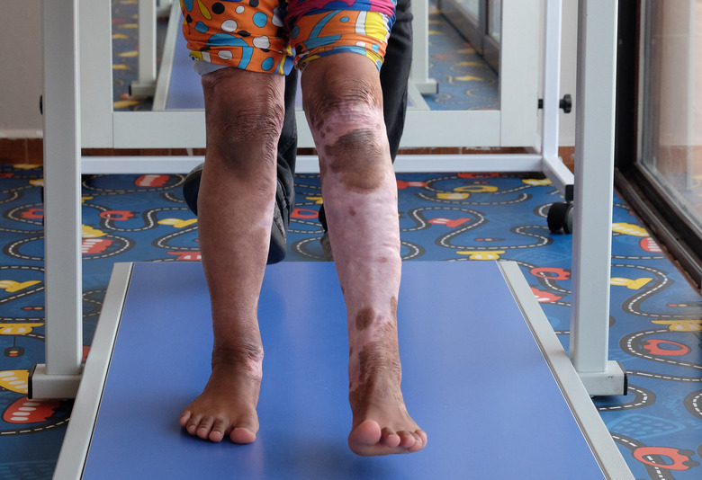 Syrian refugee Elimor, 9, undergoing treatment at a physical rehabilitation centre in Sanliurfa, south eastern Turkey, run by the UK-based charity Muntada Aid in partnership with AID Turkey. Elimor was asleep in bed when a bomb landed directly on her house in Deir Ezzor last year. The heat caused her blankets to catch fire and she suffered serious burns. She had skin graft surgery in Syria before fleeing with her family to Turkey. Because of her burns she can only walk on her toes, so she is undergoing physiotherapy to prepare her for an operation that will elongate her muscles to enable her to walk properly. (Photo by Owen Humphreys/PA Images via Getty Images)