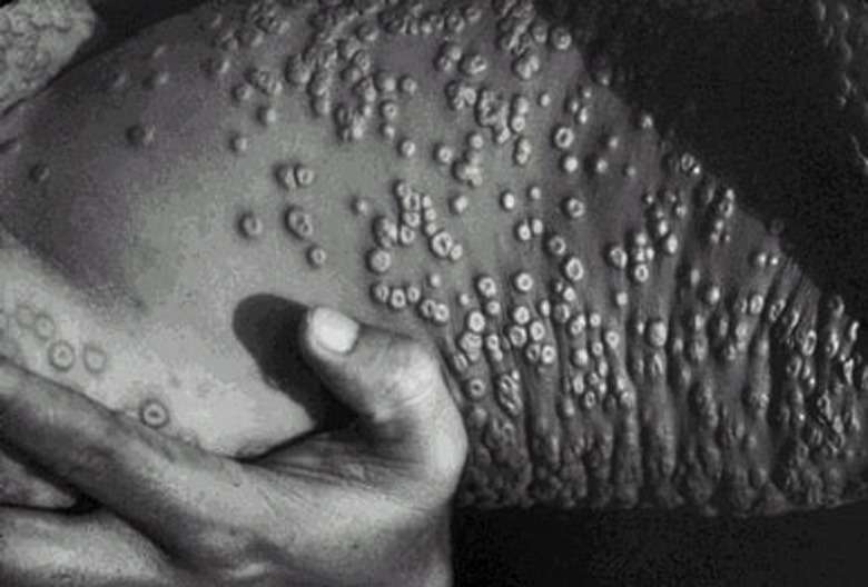 Smallpox lesions on skin are shown in this photograph taken in 1973  in Bangladesh. Smallpox infection was eliminated from the world in 1977. Smallpox is caused by variola virus with an incubation period of about 12 days following exposure. Initial symptoms include high fever, fatigue, and head and back aches. A characteristic rash, most prominent on the face, arms, and legs, follows in 2-3 days. The rash starts with flat red lesions that evolve at the same rate. Lesions become pus-filled and begin to crust early in the second week. Scabs develop and then separate and fall off after about 3-4 weeks. The majority of patients with smallpox recover, but death occurs in up to 30% of cases. Routine vaccination against smallpox ended in 1972.   &W ONLY